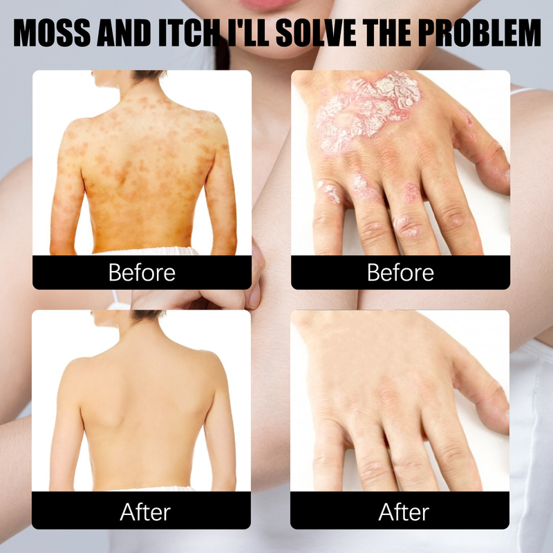 Mușchi reparator South Moon pe coapsă și piele de vacă, spray extern pentru piciorul atletului, spray sterilizant pentru piele_voghion.com