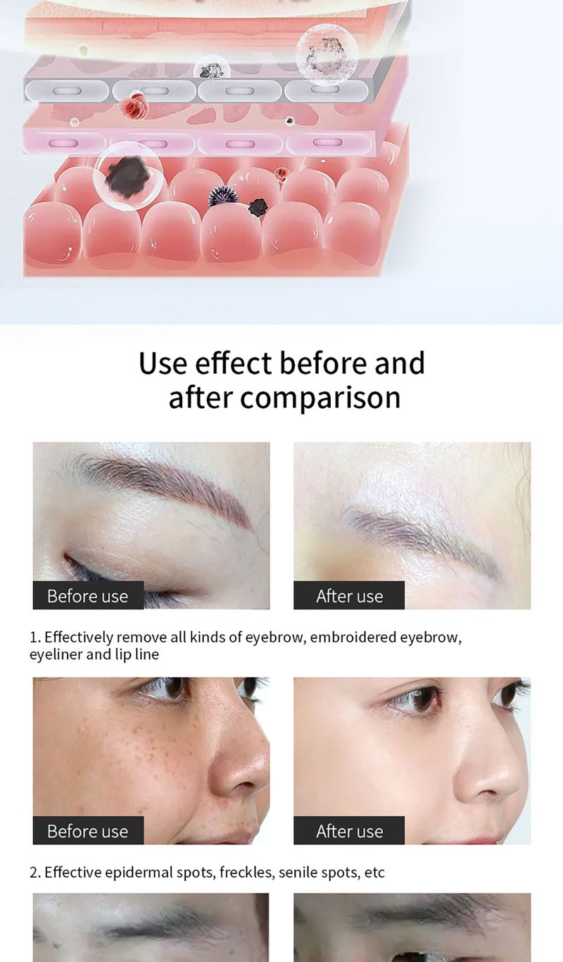 Picosecond Pen mitesszer eltávolító lézeres tetoválás eltávolító lézerrel, sötét foltokkal és demelaninnal_voghion.com