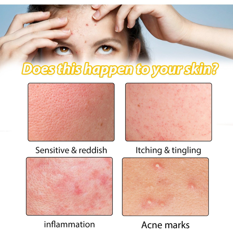 EELHOE Facial Skin Care Cleansing&Reducing Spots, Eliminating Acne and Shrinking Pore essence_voghion.com