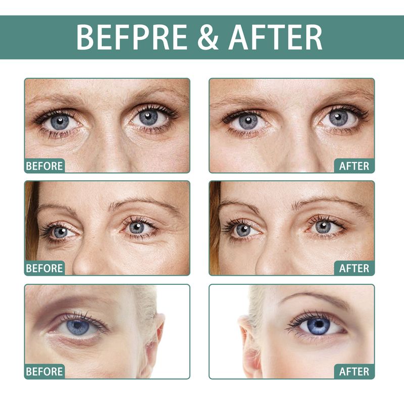 Nicotinamide oogcrème Donkere kringen Verwijdert wallen Hyaluronzuur Hydraterend serum Tegen wallen Oogverzorgingsgel_voghion.com