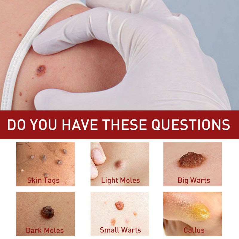 2025 Αντι-ελιές για βαθύ καθαρισμό του δέρματος, εξάλειψη κονδυλωμάτων, αφαλάτωση μαύρων ελιών, επανόρθωση και λείανση_voghion.com