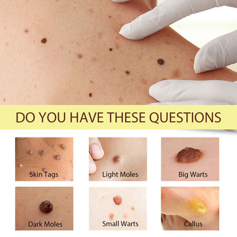 South Moon vårtkräm djuprengörande av hud, svarta nevi och kycklingögonreparation för len hud_voghion.com