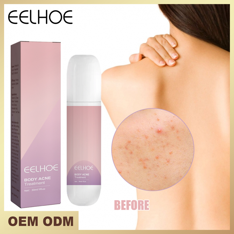 rolling Beautiful acne balls for chest and back acne, closed mouth cleaning, fade acne marks, skin care rolling balls ,_voghion.com