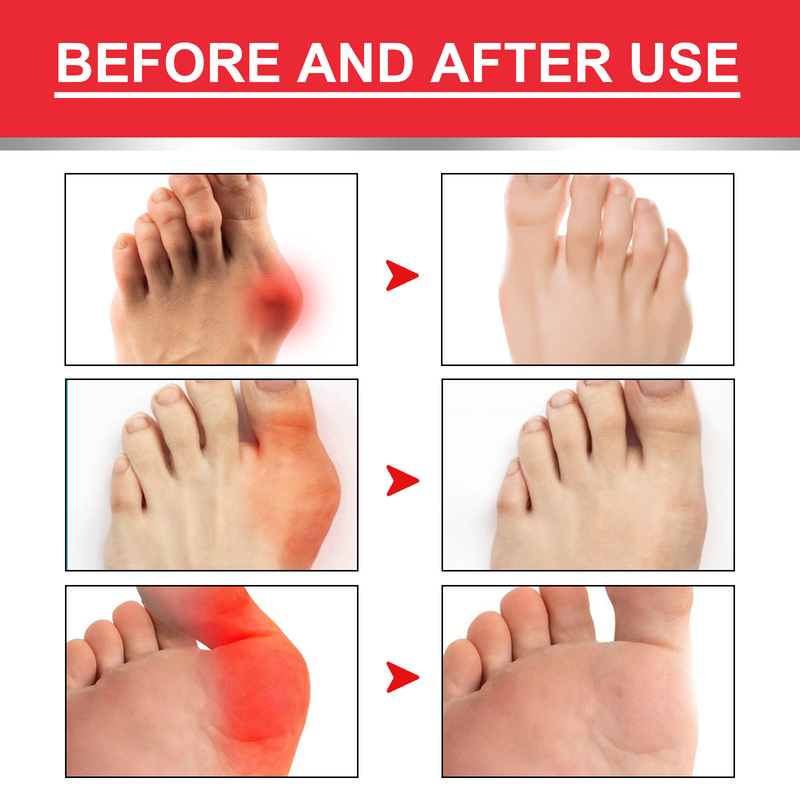 Bladder Beautiful Thumb Cream lindert Schwellungen des Daumens und der Fußsohle, Schmerz- und Gelenkpflegecreme_voghion.com