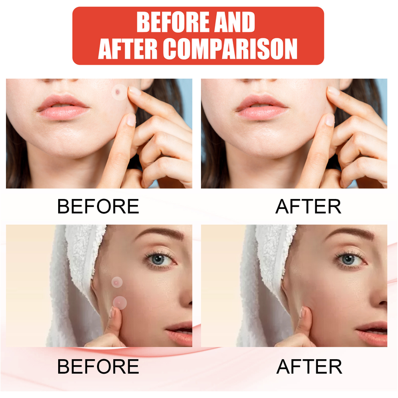 EELHOE Colloidal Patch Ansiktsbehandling Osynlig Makeup Stängd Munrengöring Vattentät och andningsbar aknehud_voghion.com