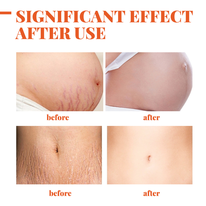 QLZHANFU Crème réparatrice contre les vergetures Crème pour la peau pour les femmes enceintes pour resserrer et desserrer les soins de la peau post-partum pour améliorer les rides_voghion.com