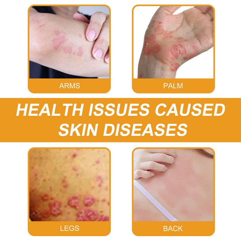 Wiyun BeesVenom Rindsleder Moos Creme Körper Haut Feuchtigkeitsspendende Linderung Beschwerden Pflege Täglichen Creme_voghion.com