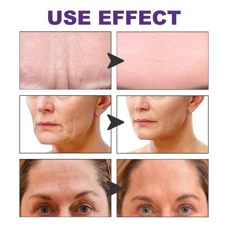 EELHOE Facial Wrinkle Patch, Droop Decree Line Lift Facial Skin Tightens Mouth Line Cheek Patch_voghion.com