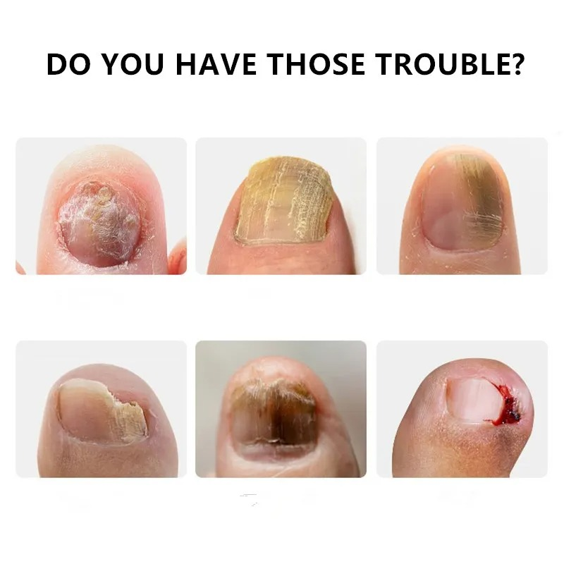 Essence de soin et de réparation des ongles à base de plantes, crème pour les ongles végétales_voghion.com