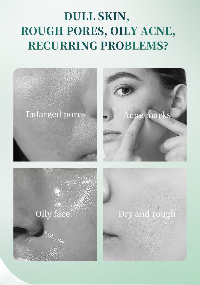 Treatments & Masks Anti Acne Facial Cream Moisturizing And Rejuvenating Acne Cream Facial Care_voghion.com