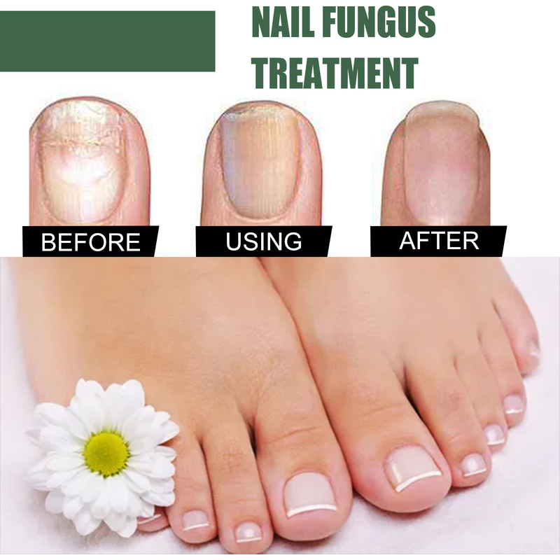 Grey Nail Beautiful Repair Thickening, Brightening, Soft Nail , Foot Care , Grey Nail Enhancement_voghion.com
