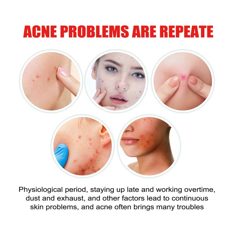 Gekleurde acne-stickers, gezichtsacne-herstellende reinigingsstickers voor de huid_voghion.com
