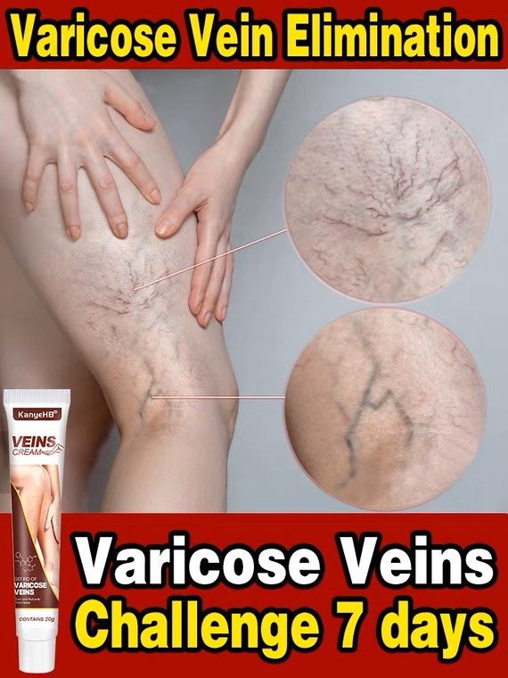 Effective Treatment of Varicose Veins Earthworm Leg Ointment for Relieving Spider Pain Vasculitis Phlebitis Pain Treatment_voghion.com