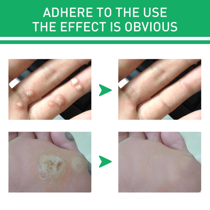 Jaysuing Mild Wart Removing Chicken Eye Smooth Skin and Foot Care Liquid_voghion.com