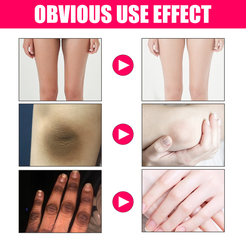 Women's Skin ELHOE Beautifying essen underarm joint brightening, whitening and lightening skin pigmentation care_voghion.com
