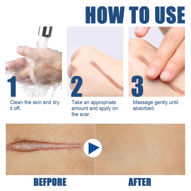 Repair Skin for Scalds, Burns, Acne Marks, Fading and Smoothing Care Scar Cream_voghion.com