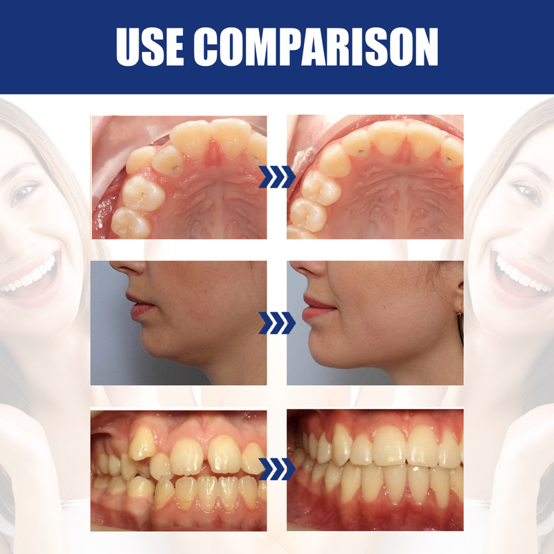 Jawbone Upassung schéine Bracket fir d'Reparatioun vu Kieferzréckzéiung an Zänn Irregularitéit, Bucktooth Oral Care Bracket_voghion.com