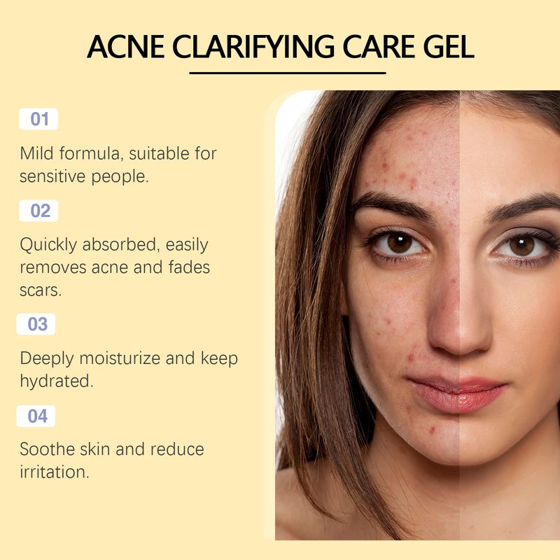 OUHOE Acne-Clearing Gel, Deep Cleansing Facial Skin Brightening And Concealer Treatment Gel For Acne Reduction_voghion.com