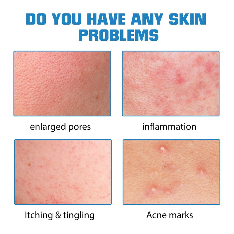 EELHOE Hyaluronsyra Ansiktsserum, fuktgivande reparation Lättare Acne Mark Hudvård Whitening Essence_voghion.com