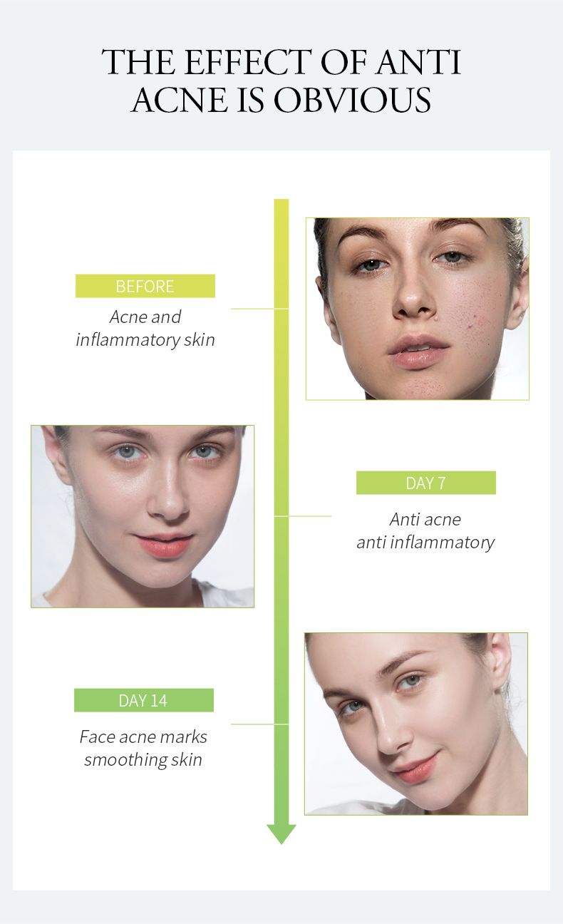 Trattamenti e maschere Crema anti-acne all'aloe vera 20 g Prodotti idratanti per la cura della pelle Confezione in inglese_voghion.com