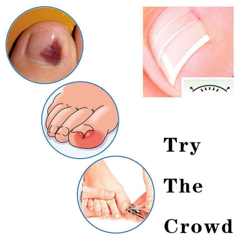 10 pièces/ensemble ongle incarné pince à redresser Patch élastique pince à redresser orthèse incurvée ongles Correction élastique autocollant_voghion.com