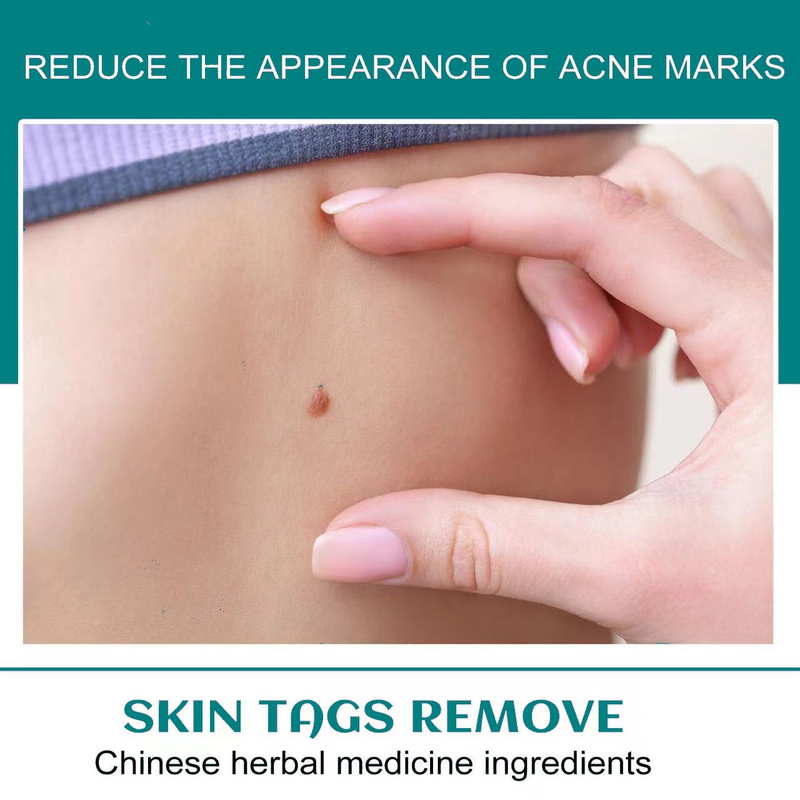 SOL LORA Pen Cream flat specially sharp Ke warts, You Ping Liquid for removing warts_voghion.com