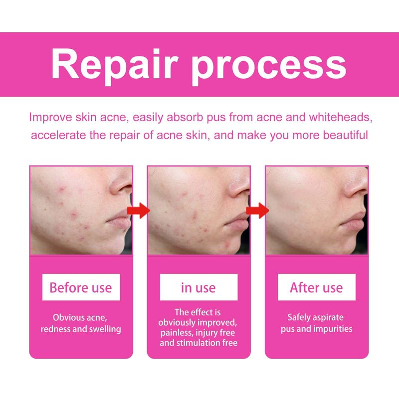 Vlinder acne pleister, huid acne verzorgingssticker hydrateert de huidelasticiteit_voghion.com