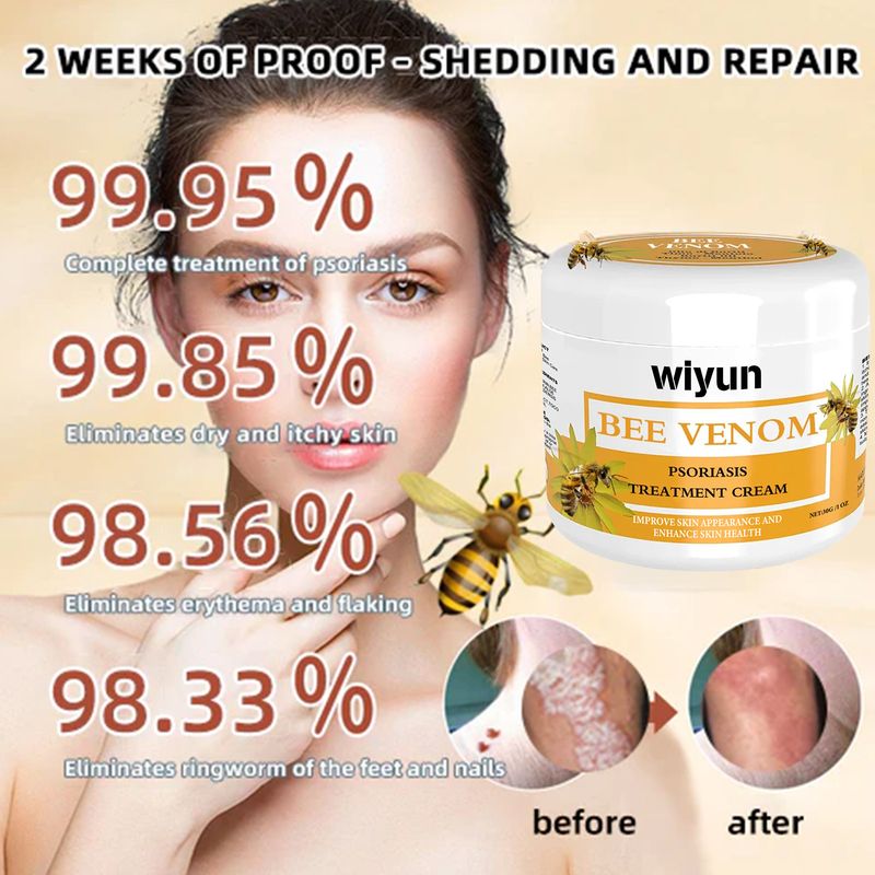 Bee Venom Leather For Redness Itching Of Moss On Hand Foot Moisturizing And Smooth Skin Care Cream_voghion.com