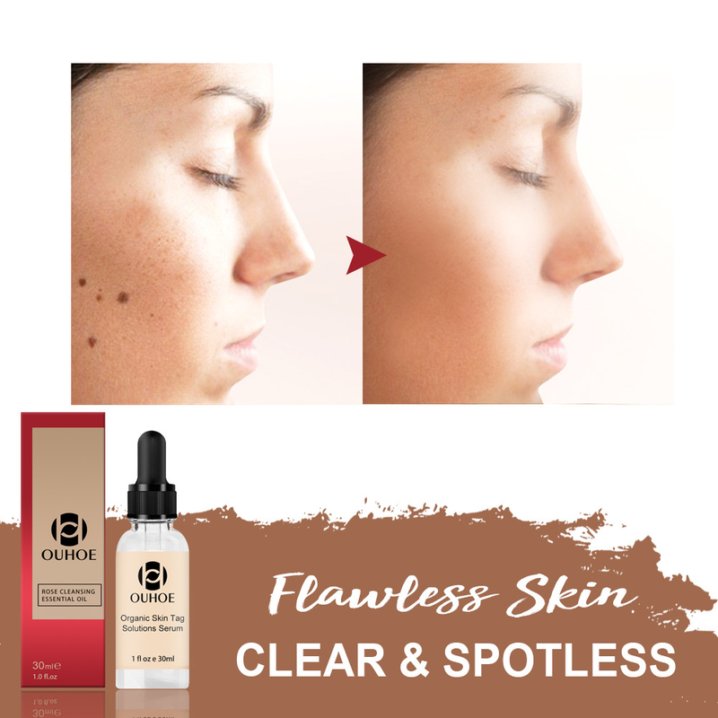 OUHOE Nevus Giderici Losyon Nevus Giderici Krem Siyah Noktaları Onarıcı ve Giderici Nevus Giderici Gül_voghion.com
