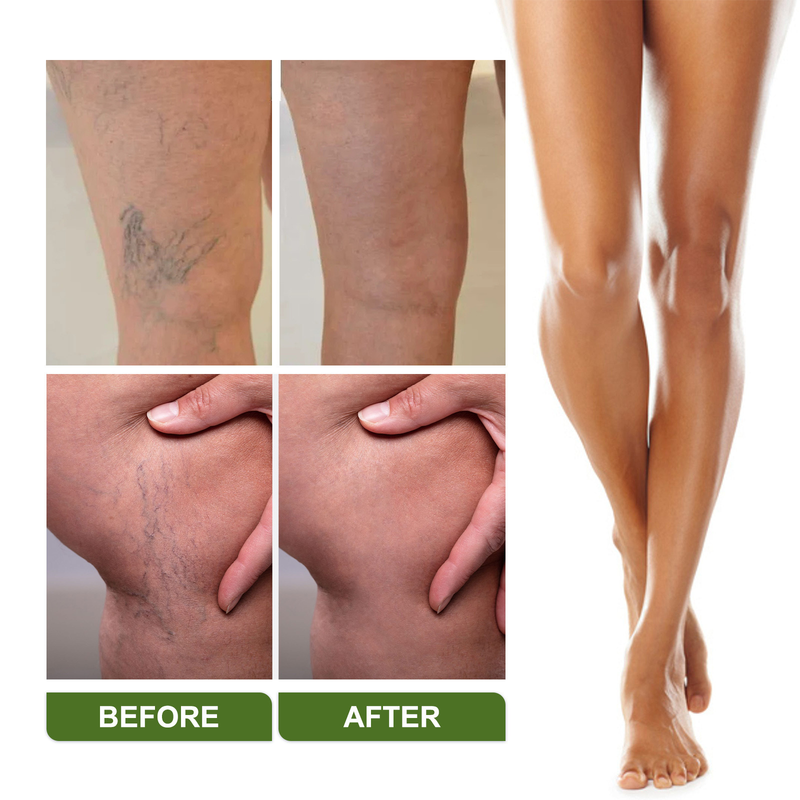 EELHOE slimming vein patch relieves swelling of veins, leg muscles, earthworm legs, body discomfort and body shaping patch_voghion.com