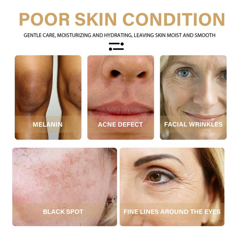 Whitening Freckle 1 STK Serum Brighten Fjern mørk plet Fade Pigment Melanin Korrigerende Facial Essence Hudpleje Kor_voghion.com