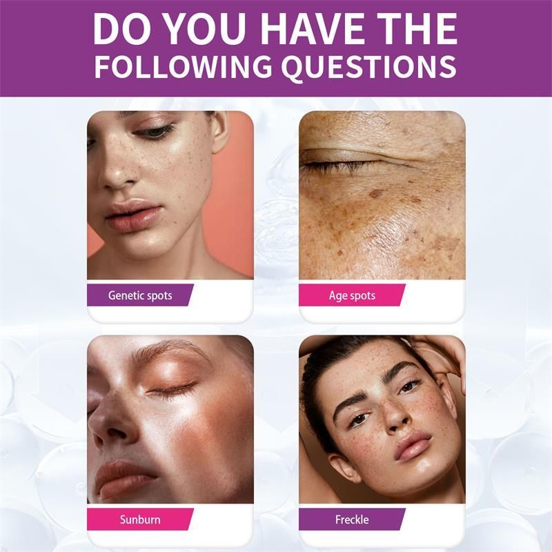Nikotinamid Hvidningscreme til fjernelse af fregner Fjerner effektivt melasma Mørke pletter Aknemærker Lysner melanin Ansigtshudpleje_voghion.com