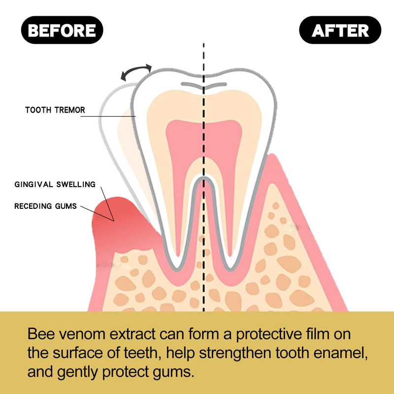 EELHOE Bienengift-Zahnfleischschutz zur Tiefenreinigung von Zahnflecken, Mundgerüchen, frischem Atem, Aufhellung T 2024_voghion.com