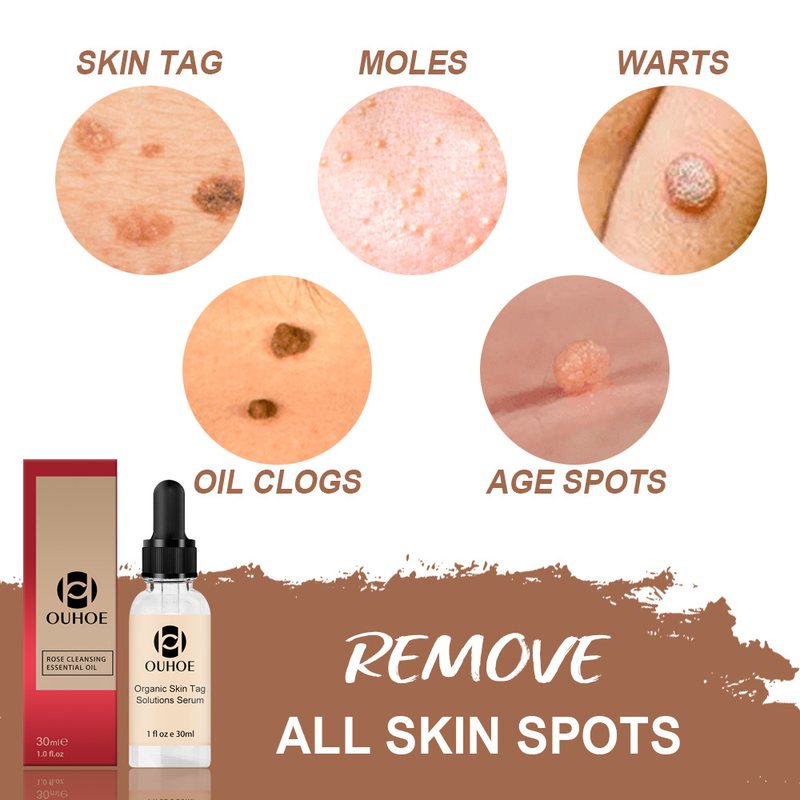 OUHOE Nevus Giderici Losyon Nevus Giderici Krem Siyah Noktaları Onarıcı ve Giderici Nevus Giderici Gül_voghion.com