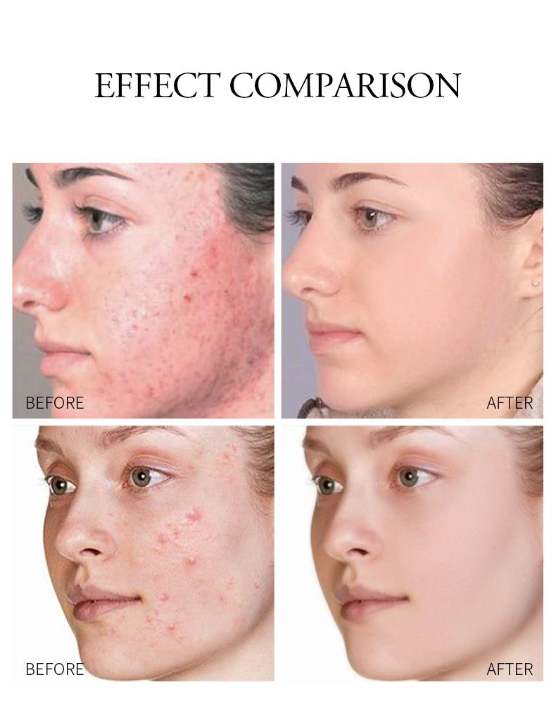 Trattamenti e maschere Crema anti-acne all'aloe vera 20 g Prodotti idratanti per la cura della pelle Confezione in inglese_voghion.com