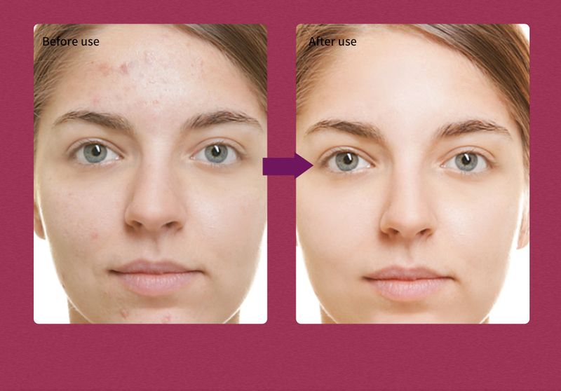AHA Essence - Trattamento per l'acne, esfoliante e siero ammorbidente alla cheratina con acido mandelico_voghion.com
