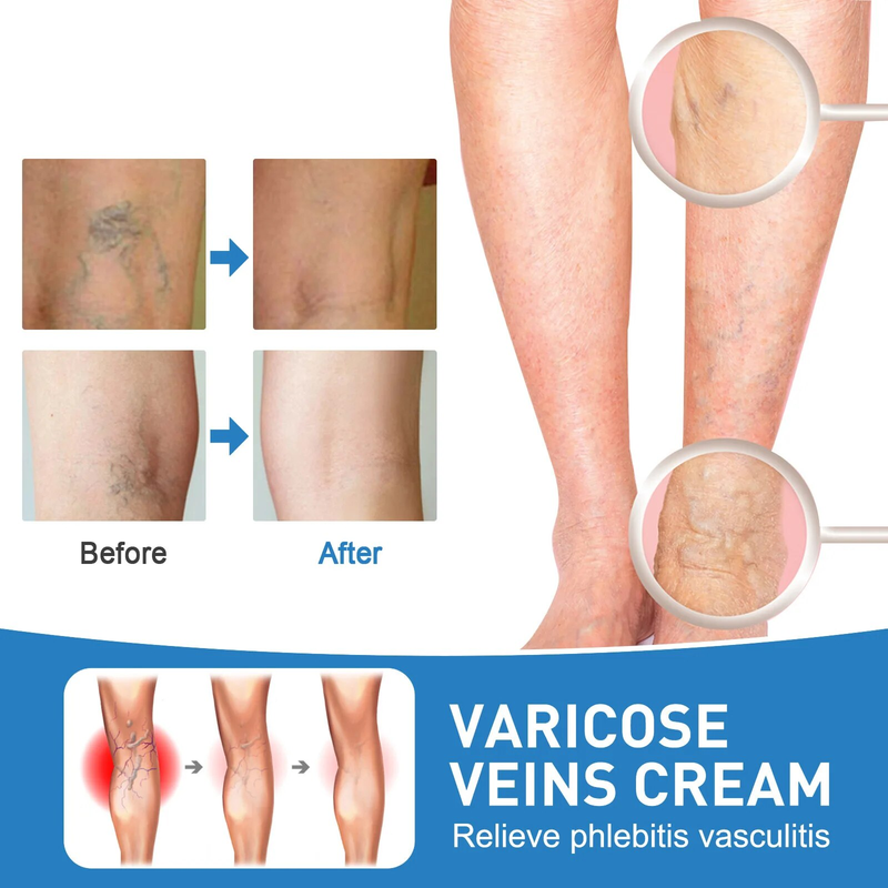 Crema per il trattamento delle vene varicose Vene del ragno Lombrico Crema per la riparazione del dolore alle gambe Seta del sangue Unguento per le gambe del ragno Assistenza sanitaria Maschio Femmina_voghion.com