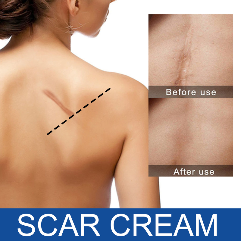 Repair Skin for Scalds, Burns, Acne Marks, Fading and Smoothing Care Scar Cream_voghion.com