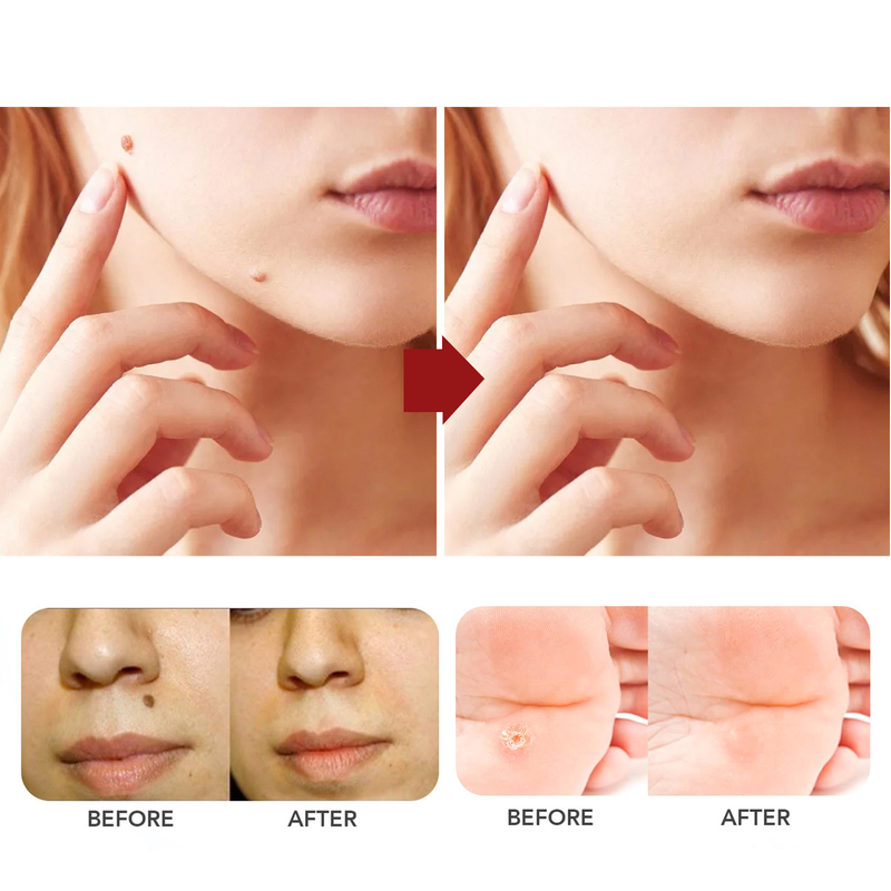 Anti Mole pour un nettoyage en profondeur de la peau, élimination des verrues, dessalinisation des grains de beauté noirs, réparation et lissage_voghion.com
