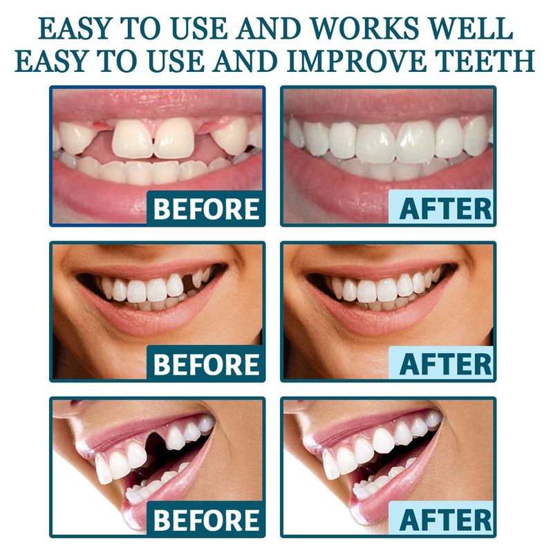 EELHOE Adjustable Snap-On Dentures Temporary Teeth Repair Braces Gap Filler Orthodontic Denture Kit_voghion.com