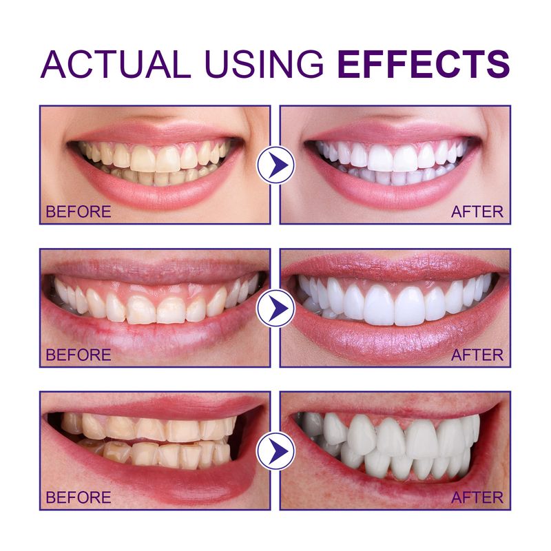 Fleckenentfernung, Aufhellung, Reinigung, Zahnfleischschutz, frischer Atem und Mundgeruchspflege, weiße Zähne_voghion.com