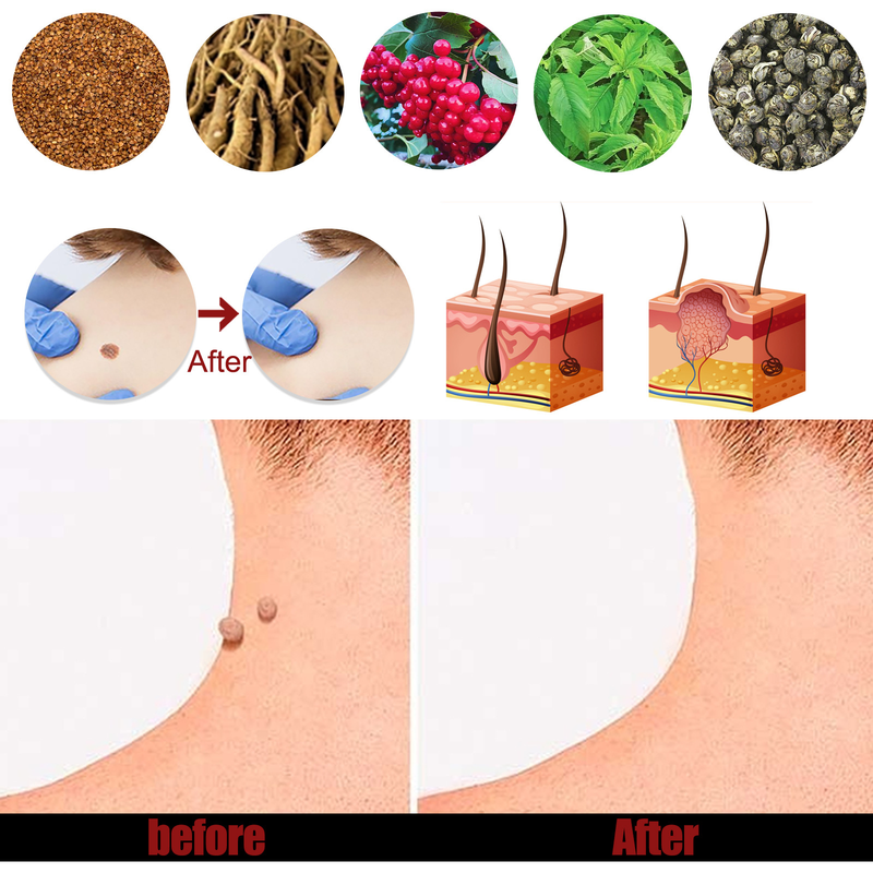 South Moon Pinghou Youke Wart Cream can suppress warts on hands, feet, face, armpits, and neck._voghion.com