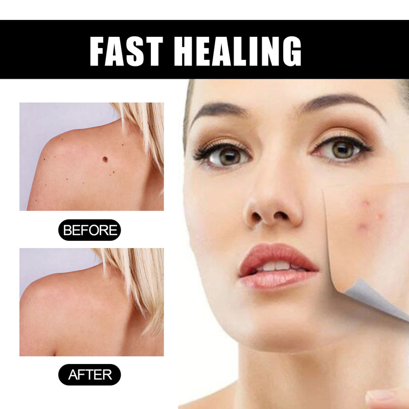 EELHOE repairing spots essence for skin flattening, wart removing and nevus eliminating solution_voghion.com