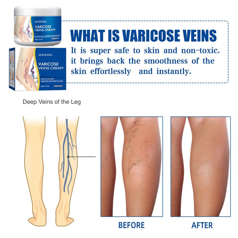 Para pernas de verme venoso com tendões e protuberâncias verdes, alívio da dor, hidratação com fio de sangue vermelho, reparo de protuberâncias, dor,_voghion.com
