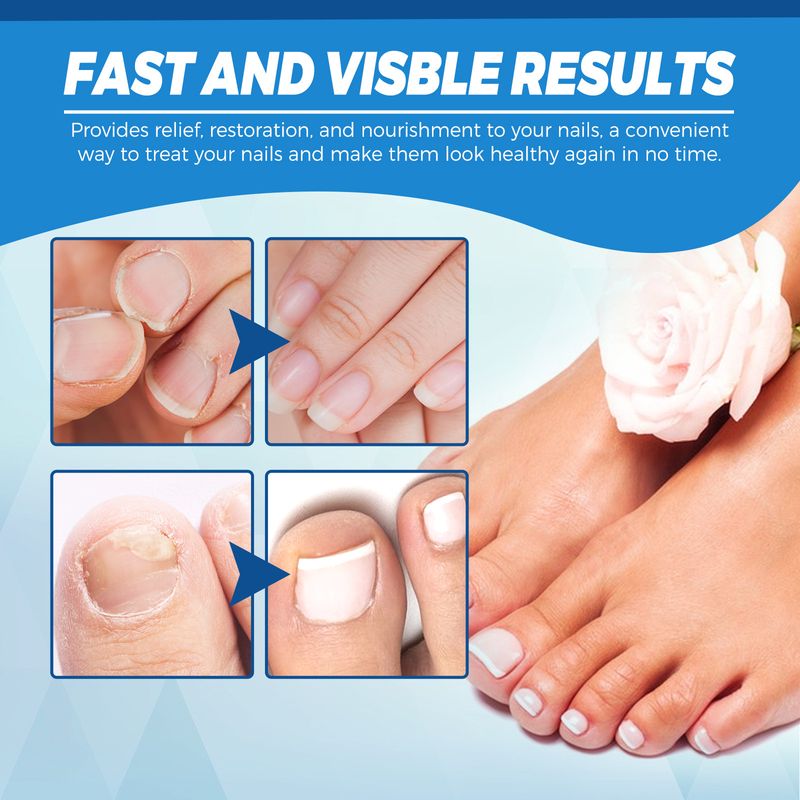 Blue Light Onychomycosis Laser Pen Simple And Easy To Use Odor Removal Nail Care_voghion.com
