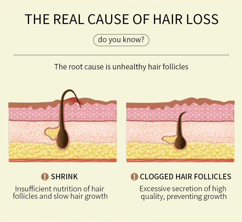 Vlasové výživné sérum – vlasový olej pro péči o pokožku hlavy, proti vypadávání vlasů a ošetření pro opětovný růst vlasů_voghion.com