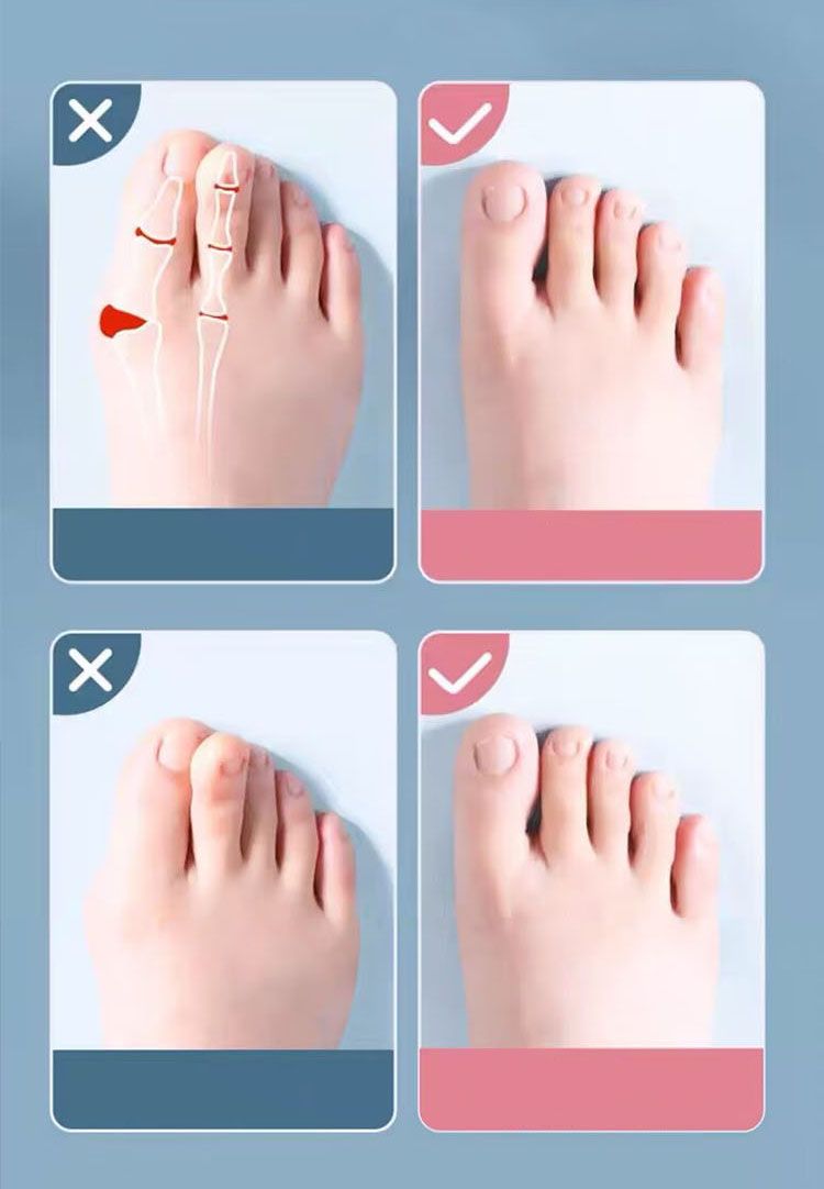 Separatore dita in silicone da 2 pezzi, dita dei piedi, divaricatore dita, alluce valgo, correttore di dita dei piedi, separatore di dita_voghion.com