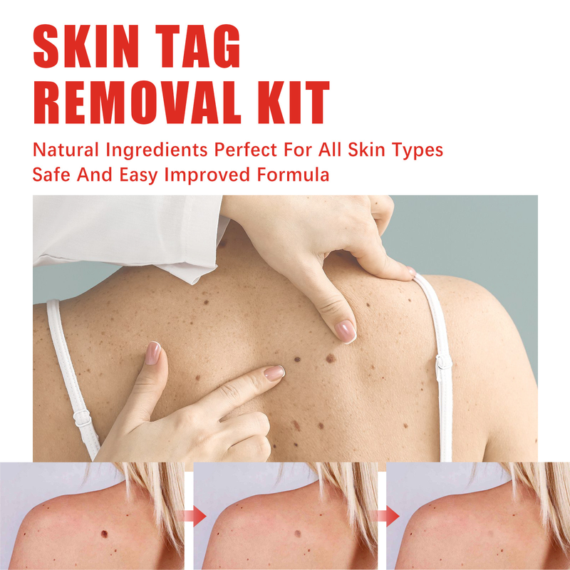 Removing Beautiful Verruca Set Skin Repair and Nevus Removing Patch Chicken Eyes, Barbs, Warts, Meat Granules Smooth B_voghion.com