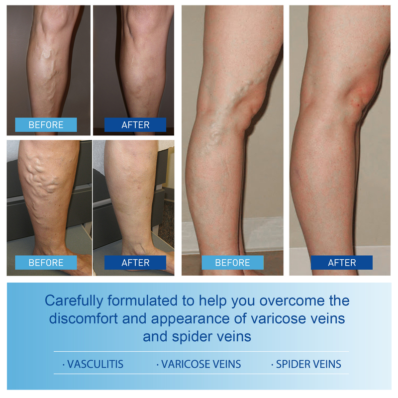 Soletta per la cura della gamba Moon South, massaggio alla suola per alleviare il gonfiore delle gambe, soletta per la cura del massaggio delle gambe con lombrico_voghion.com