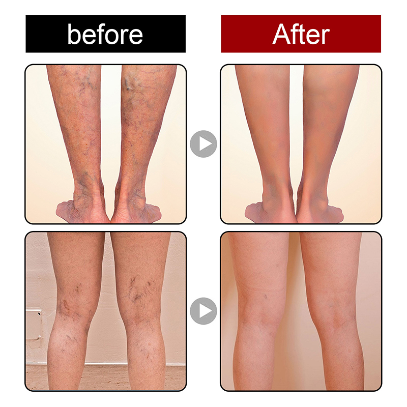 Effective Treatment of Varicose Veins Earthworm Leg Ointment for Relieving Spider Pain Vasculitis Phlebitis Pain Treatment_voghion.com
